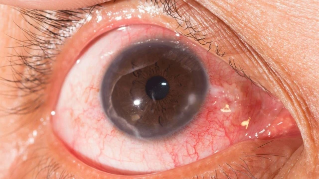 benh/viem-giac-mac-cham-nong.html