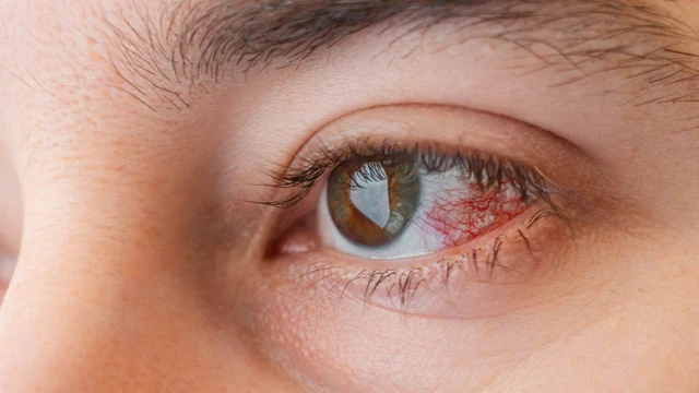 bai-viet/viem-giac-mac-co-nguy-hiem-khong-nhung-dieu-ban-can-biet.html