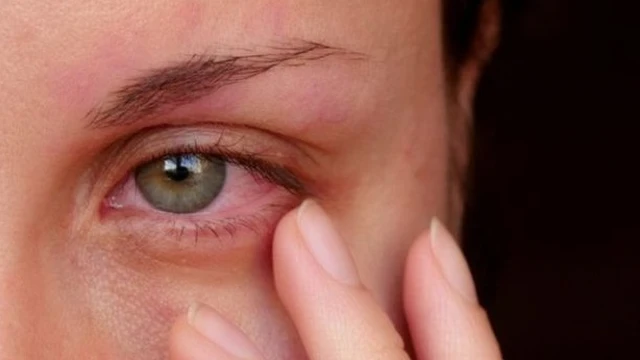 bai-viet/viem-giac-mac-kieng-an-gi-nguyen-nhan-va-dau-hieu-cua-viem-giac-mac.html