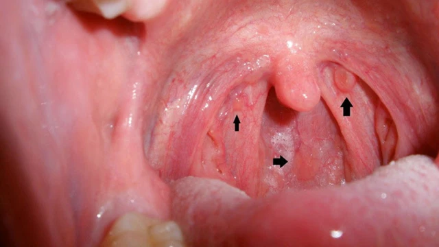  Viêm họng hạt mãn tính và những điều cần biết 1