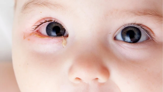 Viêm kết mạc mắt ở trẻ em