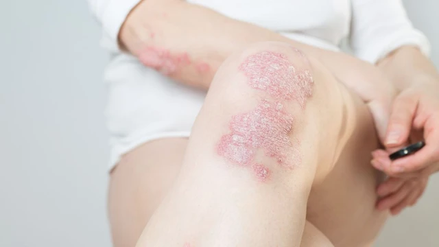 bai-viet/viem-khop-vay-nen-co-chua-duoc-khong-trieu-chung-nhan-biet-viem-khop-vay-nen.html