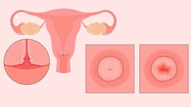 bai-viet/lo-tuyen-tu-cung-la-gi-cach-phong-ngua-viem-lo-tuyen-tu-cung.html