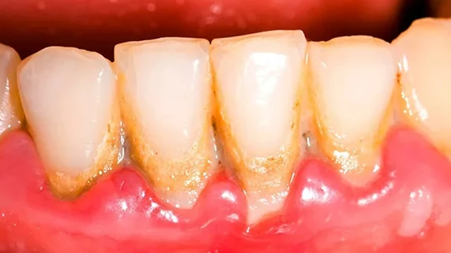 bai-viet/viem-loi-mang-bam-nguy-hiem-nhu-the-nao.html