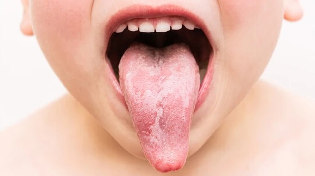 bai-viet/viem-luoi-ban-do-co-nguy-hiem-khong.html