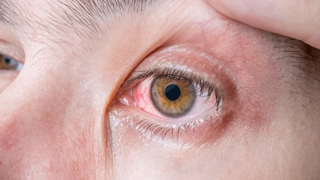 bai-viet/dieu-tri-viem-mang-bo-dao-bao-lau-thi-khoi.html