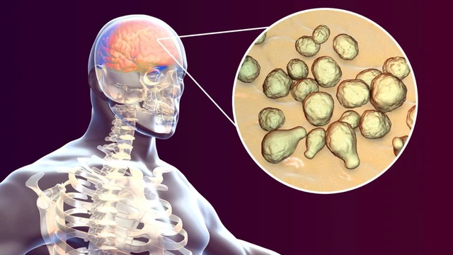 bai-viet/viem-mang-nao-mo-cau-co-can-nhap-vien-khong.html