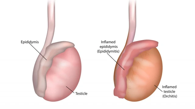 Viêm mào tinh hoàn là gì? Nguyên nhân, triệu chứng và cách điều trị 1