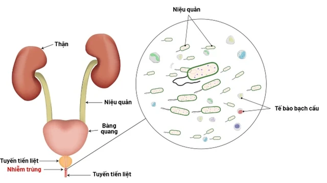 bai-viet/viem-nieu-dao-co-mu-nguyen-nhan-trieu-chung-va-cach-dieu-tri-hieu-qua.html