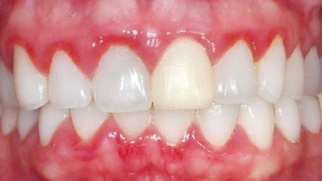 bai-viet/viem-nuou-trien-duong-nguyen-nhan-dau-hieu-va-cach-dieu-tri.html