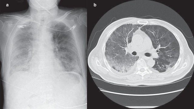 bai-viet/tim-hieu-tong-quan-ve-viem-phoi-ke-sau-covid-19.html