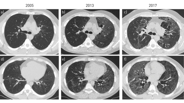 Viêm phổi kẽ tróc vảy là gì? Nguyên nhân và cách điều trị viêm phổi kẽ tróc vảy 2