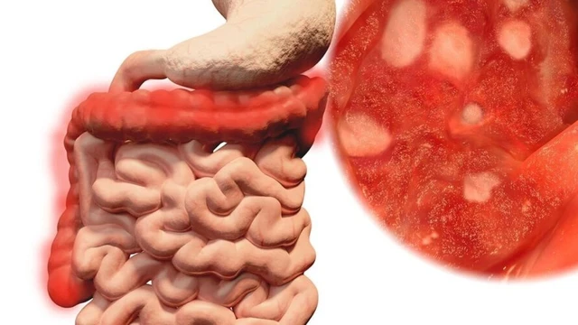 bai-viet/viem-ruot-cap-tinh-la-benh-gi-nguyen-nhan-trieu-chung-phuong-phap-dieu-tri-va-phong-ngua.html