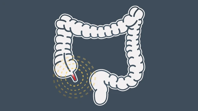 bai-viet/viem-ruot-thua-co-nguy-hiem-khong-phuong-phap-dieu-tri-benh-viem-ruot-thua.html