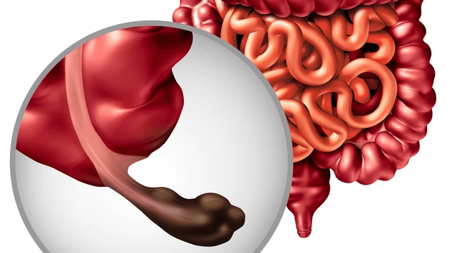 bai-viet/cach-phan-biet-viem-ruot-thua-va-viem-tui-mat-ban-can-biet.html