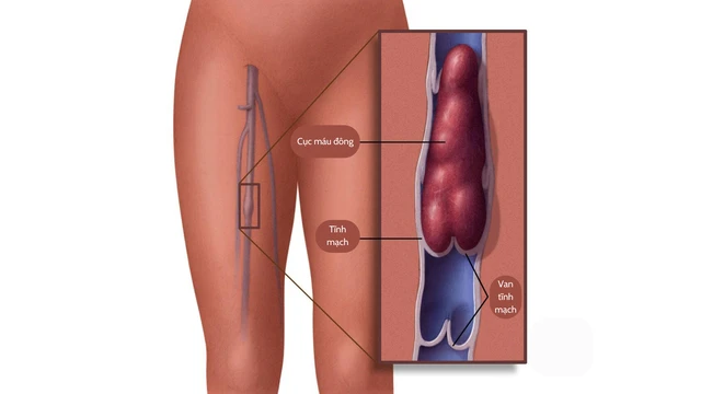 benh/viem-tac-tinh-mach.html