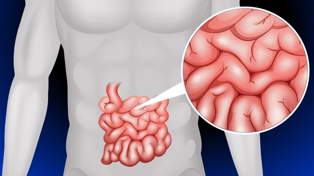 bai-viet/viem-tui-thua-meckel-la-gi-bien-chung-co-the-gap-phai-khi-bi-viem-tui-thua-meckel.html