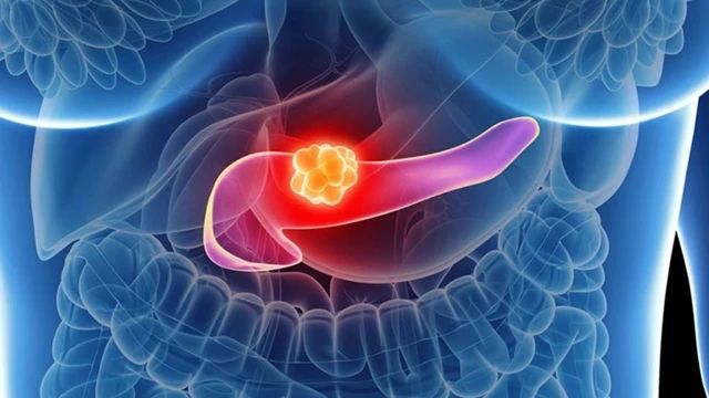 bai-viet/viem-tuy-tu-mien-nhung-dieu-can-biet.html