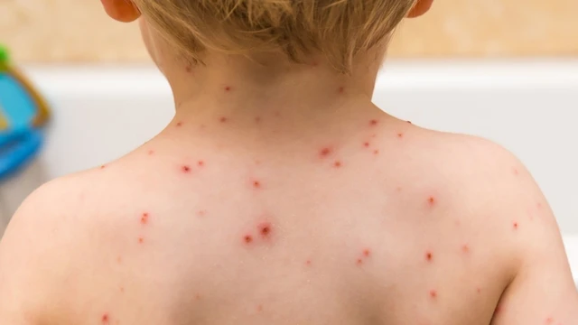 bai-viet/virus-thuy-dau-song-trong-bao-lau-cach-chua-tri-va-phong-ngua.html