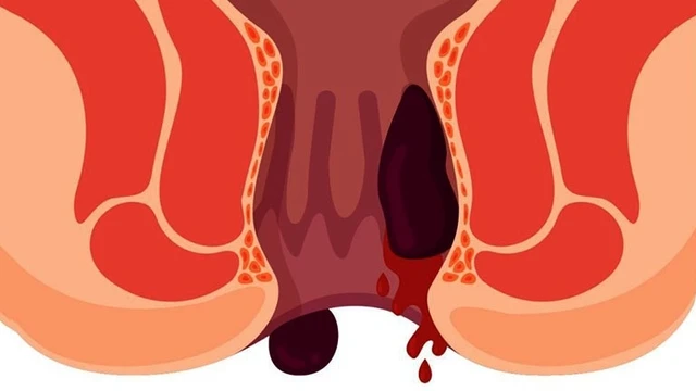 bai-viet/vo-bui-tri-chay-mau-phai-lam-sao.html