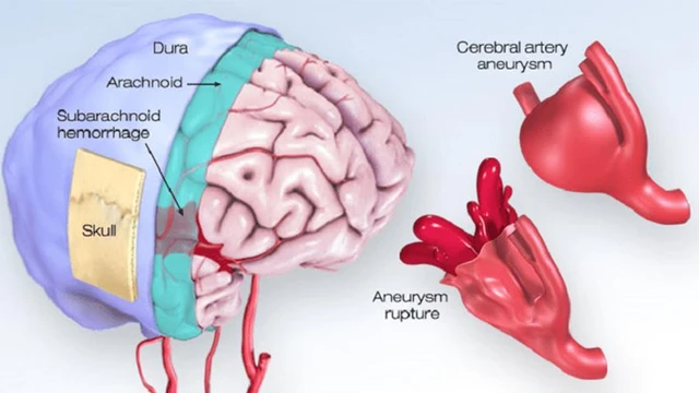 benh/vo-mach-mau-nao.html