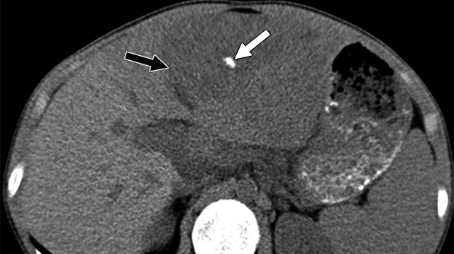 bai-viet/voi-hoa-gan-la-benh-gi-dieu-tri-benh-voi-hoa-gan-nhu-the-nao.html