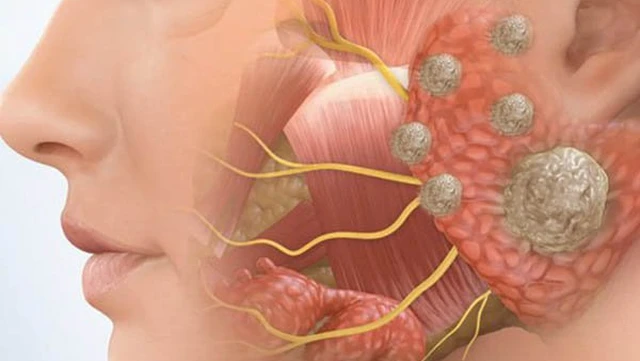 bai-viet/voi-hoa-tuyen-nuoc-bot-la-benh-gi-co-nguy-hiem-khong.html