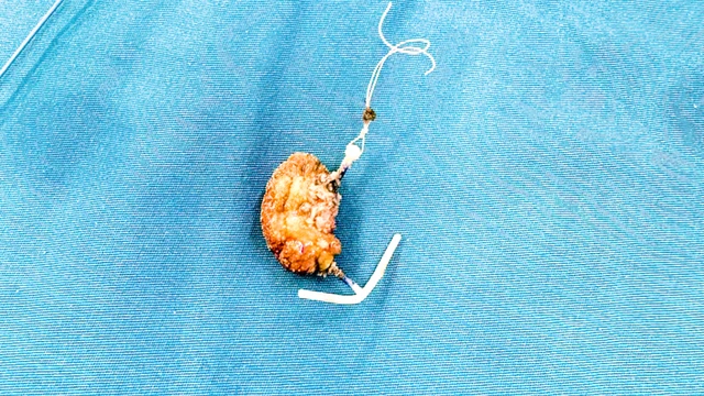 Vòng tránh thai “đi lạc” vào bàng quang 22 năm, bệnh nhân phải mổ vì sỏi bám dày