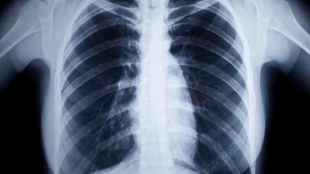 bai-viet/x-quang-gian-phe-quan-va-vai-tro-trong-danh-gia-benh-ho-hap.html