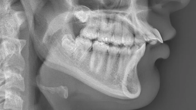 bai-viet/x-quang-ham-chech-phuong-phap-chan-doan-hieu-qua-trong-nha-khoa.html