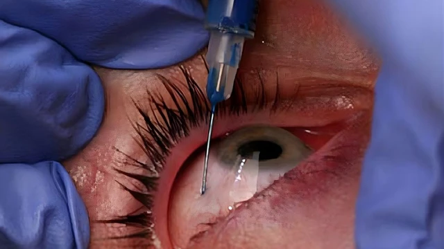 bai-viet/xam-trong-mat-nhung-nguy-co-suc-khoe-ban-can-biet-truoc-khi-thuc-hien.html