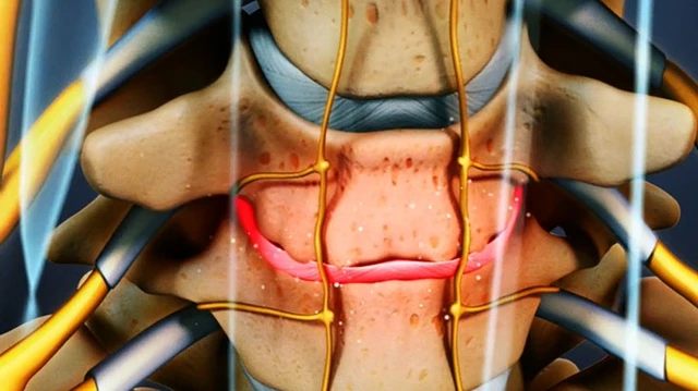 bai-viet/xep-dia-dem-nguyen-nhan-dau-hieu-va-bien-phap-phong-ngua.html