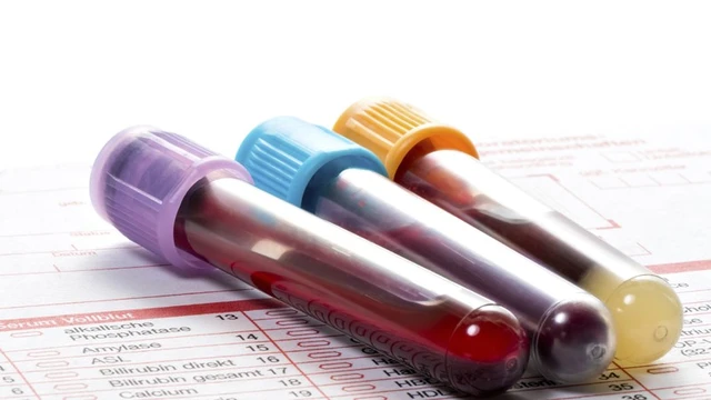 bai-viet/y-nghia-cua-xet-nghiem-beta2-microglobulin-trong-chan-doan-benh-ly.html
