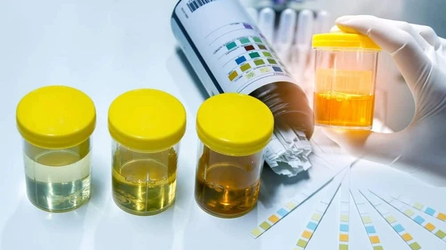 bai-viet/xet-nghiem-can-addis-phuong-phap-chan-doan-hoi-chung-than-hu-hieu-qua.html