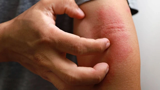 bai-viet/xet-nghiem-di-ung-thuoc-khang-sinh-o-dau-chinh-xac-khi-nao-nen-thuc-hien.html