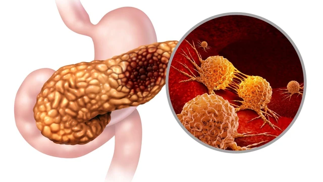 bai-viet/xet-nghiem-men-tuy-va-cac-xet-nghiem-khac-trong-viem-tuy-cap.html