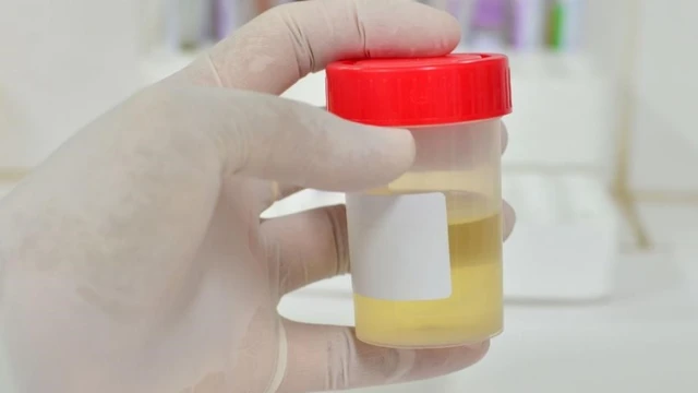 bai-viet/xet-nghiem-microalbumin-nieu-phat-hien-duoc-nhung-benh-gi.html