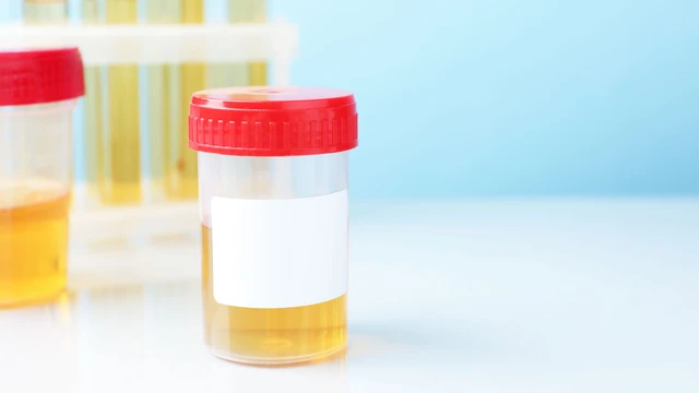 bai-viet/xet-nghiem-nuoc-tieu-bao-lau-co-ket-qua-truong-hop-nao-can-xet-nghiem-nuoc-tieu.html