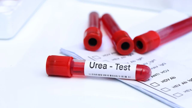 Xét nghiệm ure máu để làm gì? Lưu ý khi làm xét nghiệm ure máu