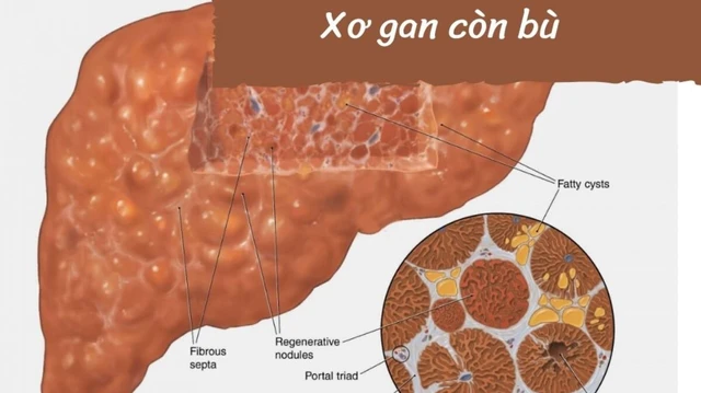 benh/xo-gan-con-bu.html