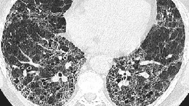 bai-viet/xo-phoi-vo-can-la-gi-nguyen-nhan-dau-hieu-va-cach-nhan-biet-60963.html