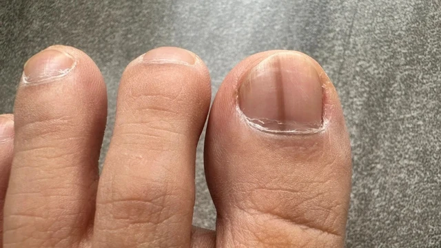 bai-viet/xuat-hien-vet-nau-duoi-mong-chan.html