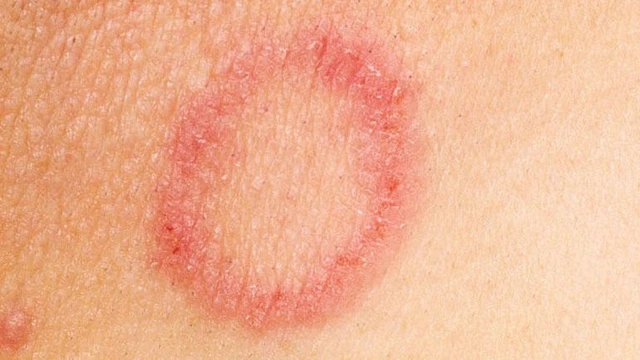 bai-viet/xuat-hien-vet-tron-bi-noi-dom-do-tren-da-va-ngua-la-do-dau.html