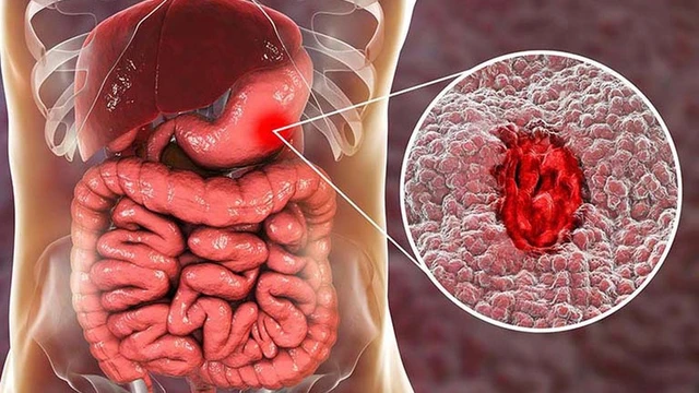 bai-viet/xuat-huyet-da-day-non-ra-mau-co-nguy-hiem-khong.html