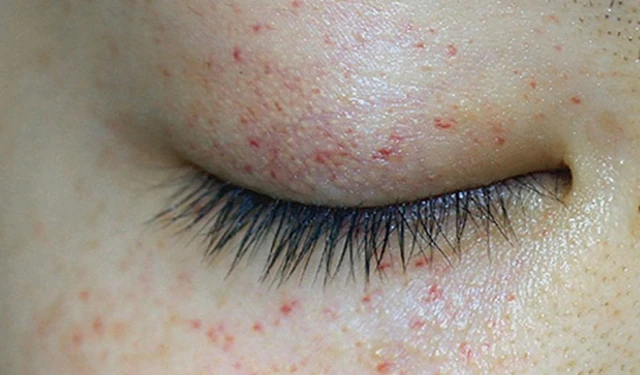 bai-viet/xuat-huyet-duoi-da-quanh-mat-va-dieu-can-biet-54379.html