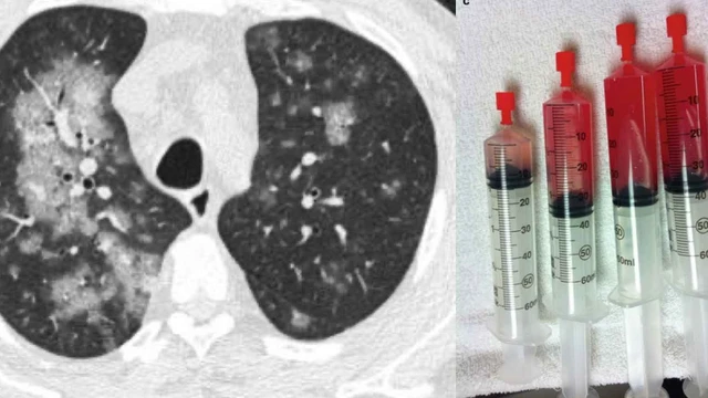 benh/xuat-huyet-phe-nang-lan-toa.html