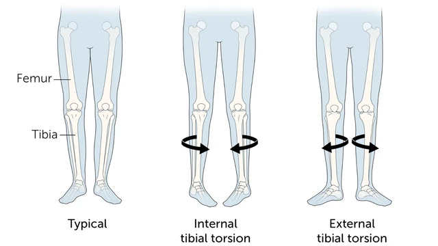 benh/xoan-xuong-chay.html