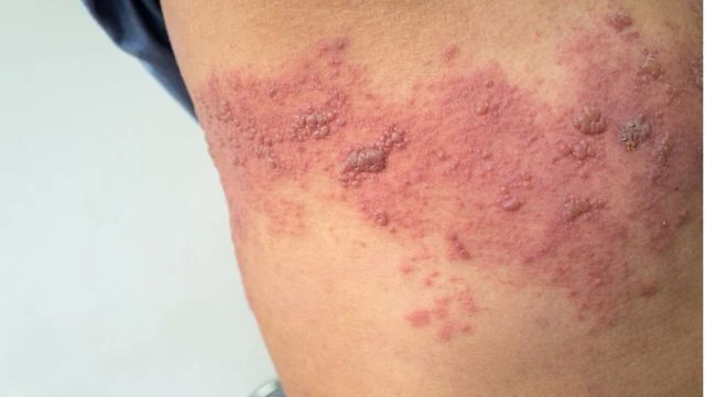 bai-viet/zona-o-bung-cach-dieu-tri-va-cham-soc.html