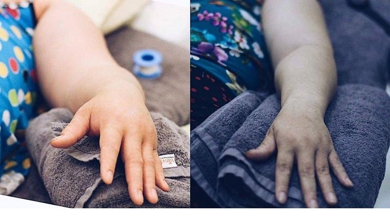 Những điều cần biết về phù bạch huyết ở bệnh nhân ung thư3