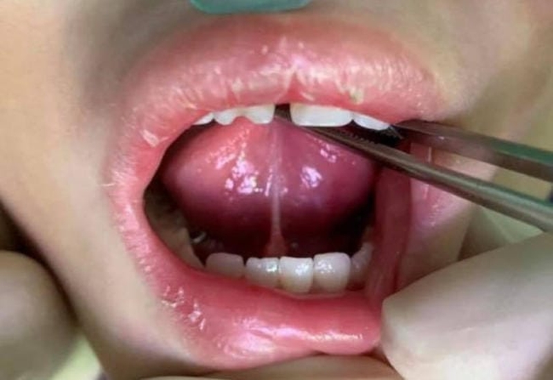 Điều trị tật dính thắng lưỡi độ 4 như thế nào? 3